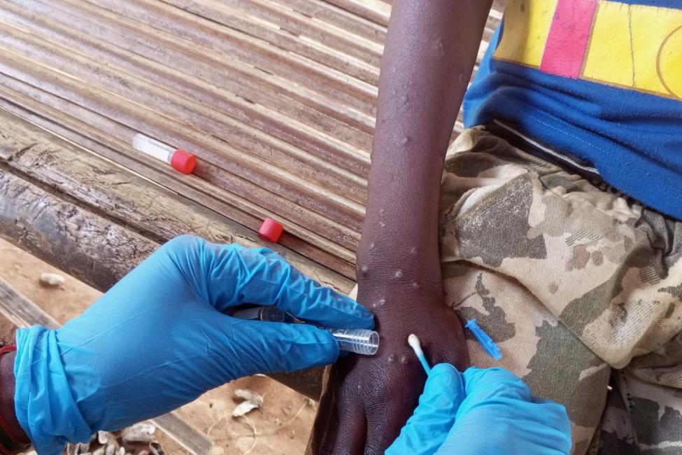 IOM Appeals for USD 18.5 Million to Urgently Aid Mpox-Affected Populations in East, Southern Africa IOM Appeals for USD 18.5 Million to Urgently Aid Mpox-Affected Populations in East, Southern Africa
